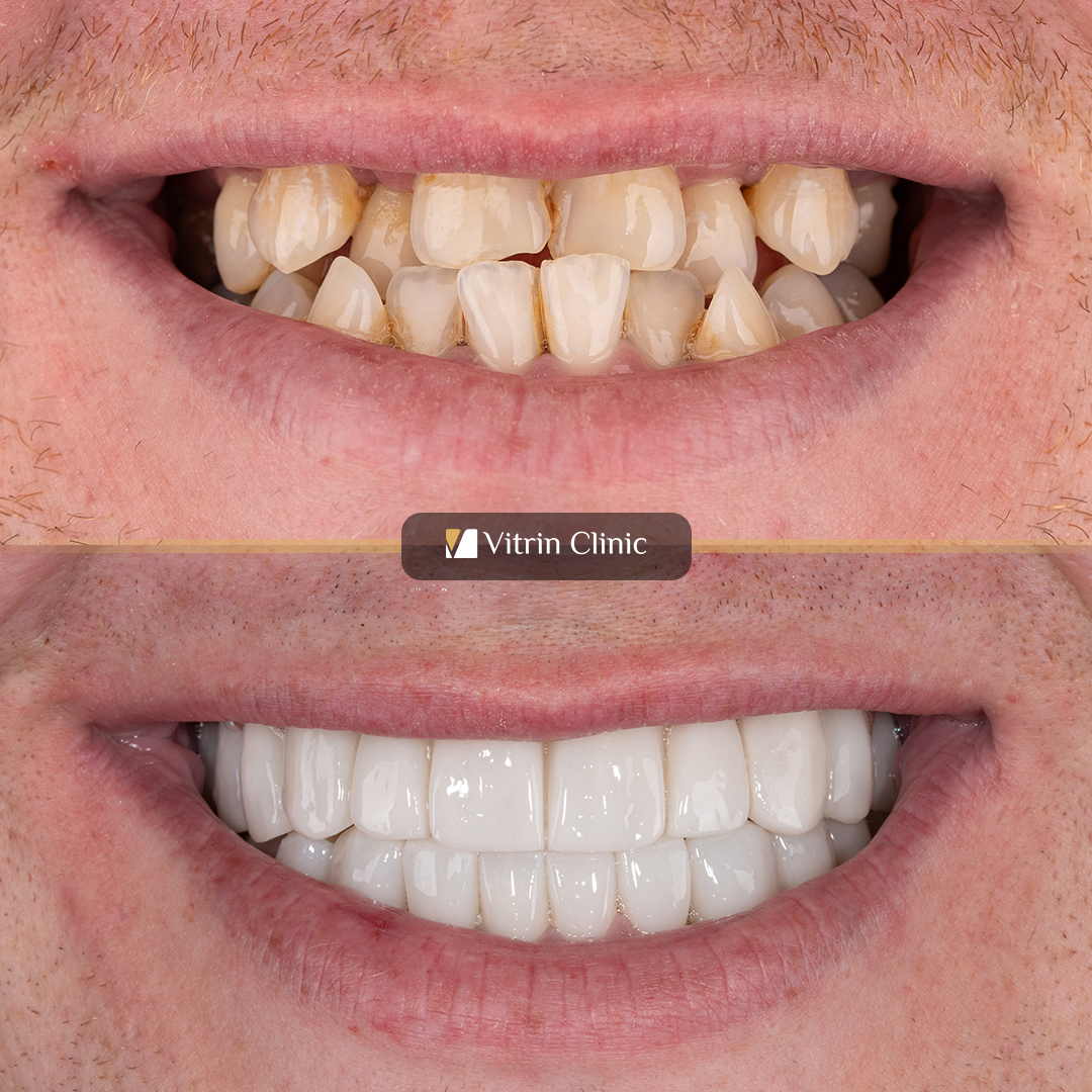 Full Mouth Dental Crowns in Turkey: Cost, Materials, Process & Results